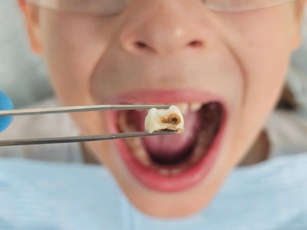 Best Emergency Wisdom Teeth Removal in Livingston, TX